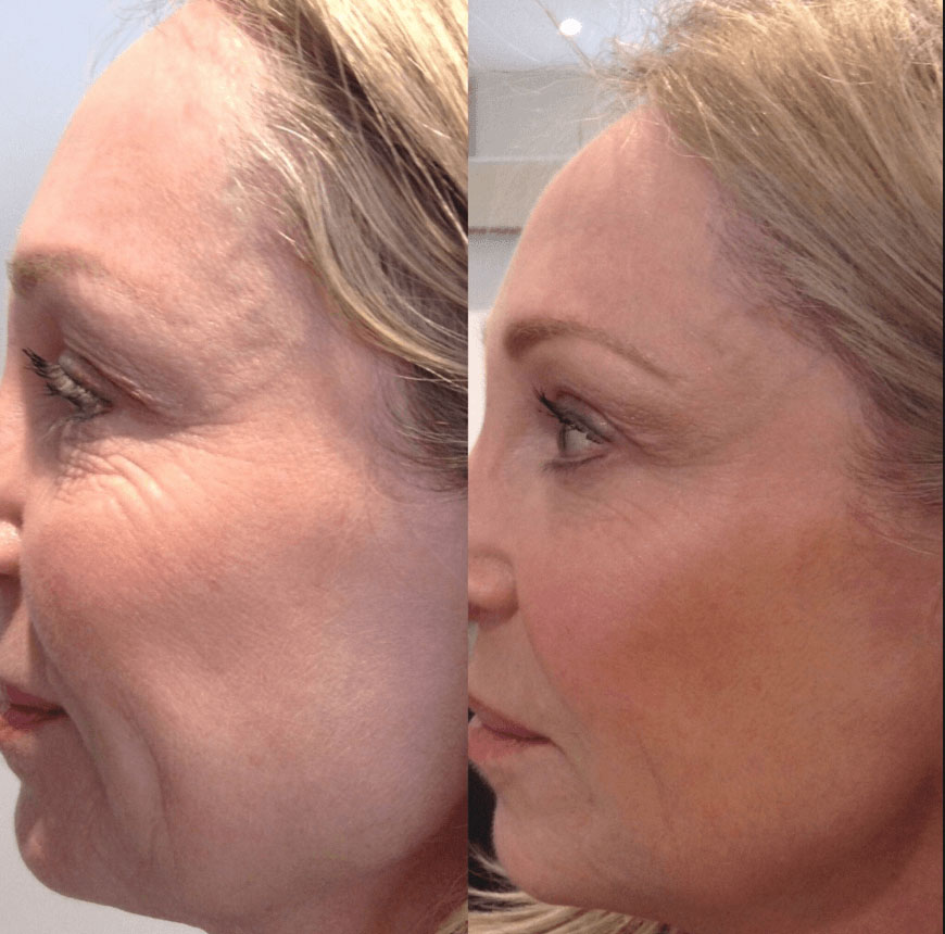 Före och efter Profhilo, kind och käklinje